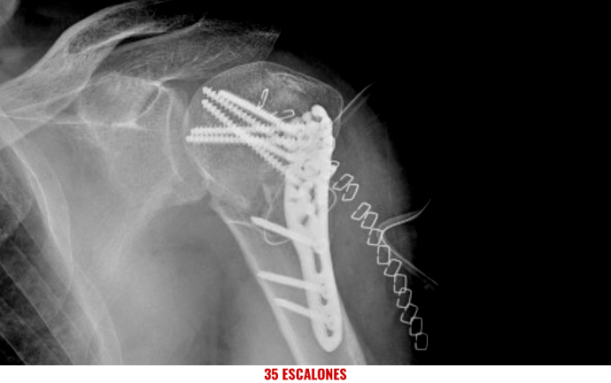 Radiografía de placa atornillada con ocho tornillos a humero del brazo izquierdo